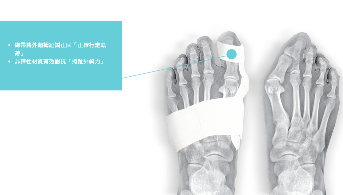 綁帶將外翻拇趾矯正回「正確行走軌跡非彈性材質有效對抗「拇趾外斜力」