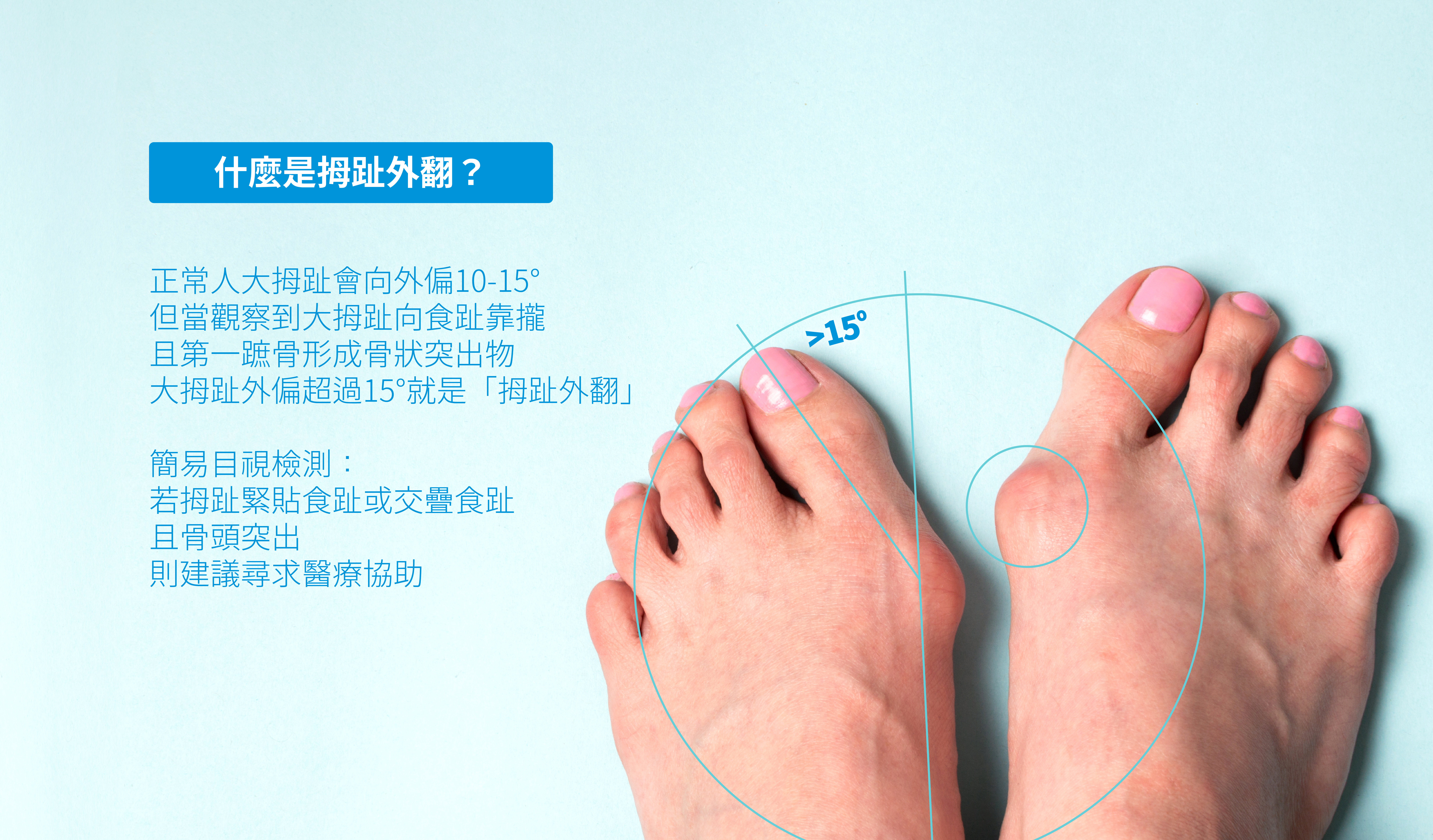 德國 豪樂適 拇趾外翻矯正器hallufix For Bunion Pain Hallux Valgus Pchome 24h購物